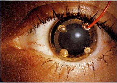  ERG-jet角膜接觸鏡電極